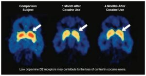 Three PET brain scans compare dopamine D2 receptor levels before and after cocaine use.